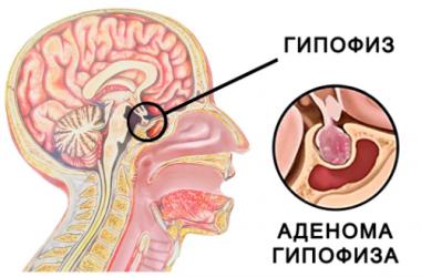 Симптомы аденомы гипофиза головного мозга у женщин