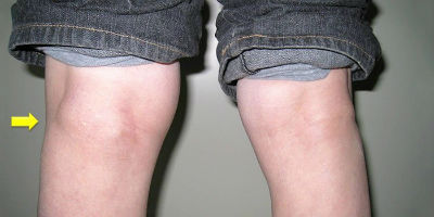 разрыв кисты коленного сустава