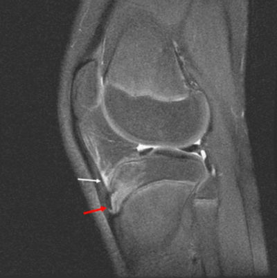 Что показывает МРТ коленного сустава thumbnail