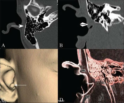 Ангиография внутреннего уха при МРТ