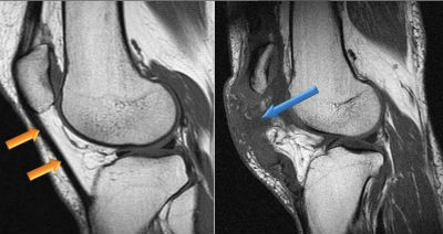 Что покажет МРТ при заболеваниях коленного сустава thumbnail