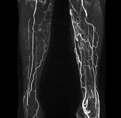 снимки ангиографии сосудов нижних конечностей