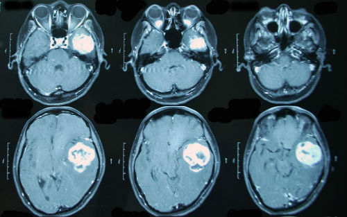 явные изменения на снимках МРТ головного мозга