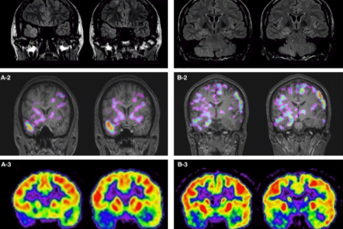Влияние просмотра фильмов ужасов на МРТ головного мозга